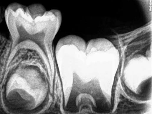 Oral Cancer